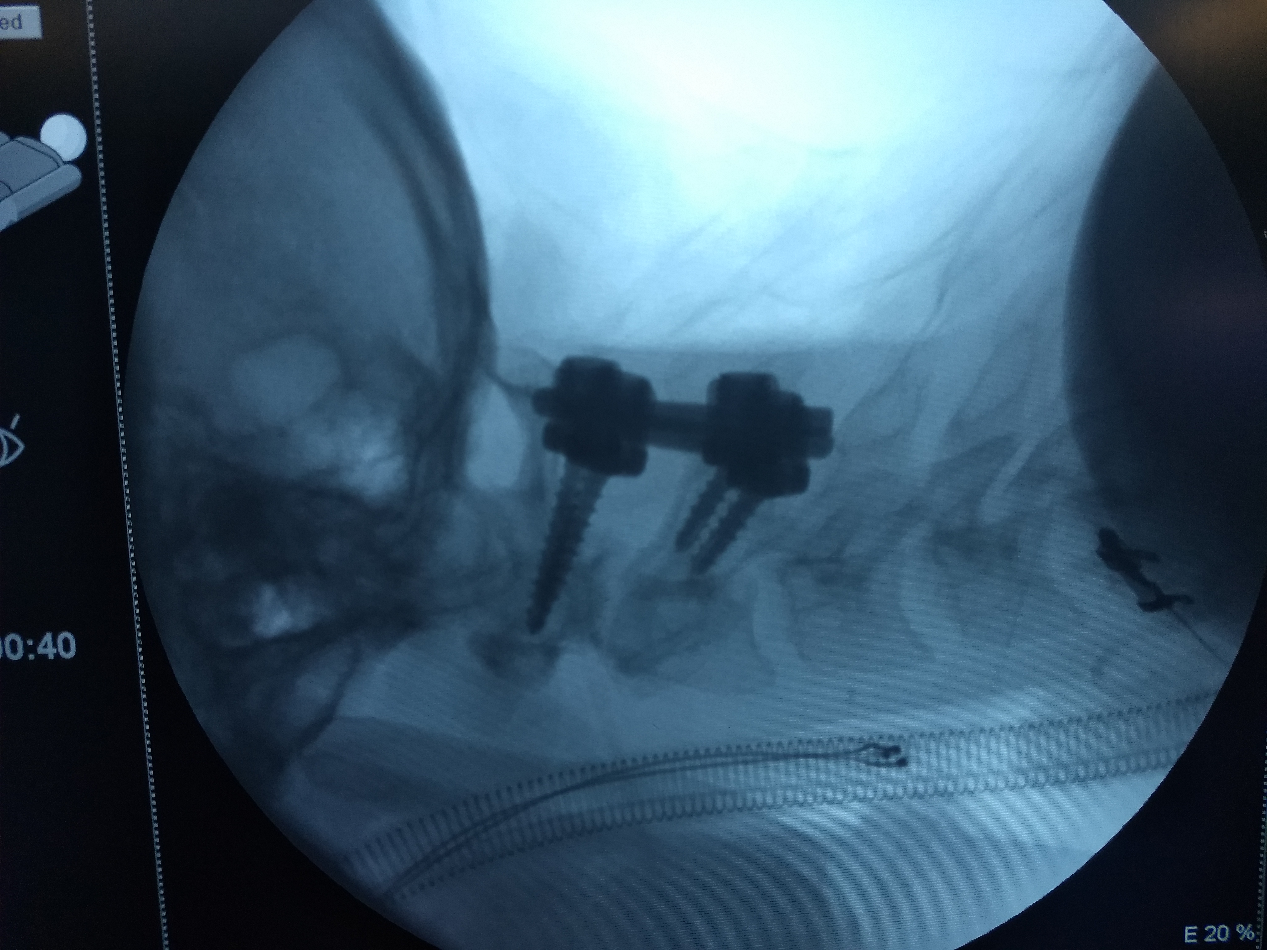 Cervical Spine Trauma